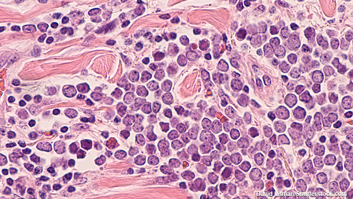 Merkel cell carcinoma